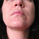 Day 3 peel 2